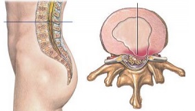 Люмбаго: симптомы, причины, лечение. Ишиас и люмбаго3