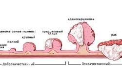 Стадии развития рака