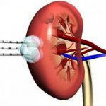 Гиперваскулярное образование на почке: что это, виды и лечение