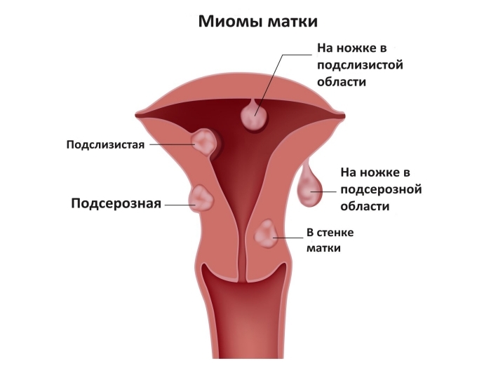 Польза маточного гнезда при миомах матки