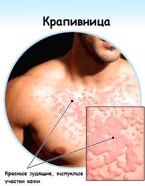 Крапивница у взрослого с симптомами