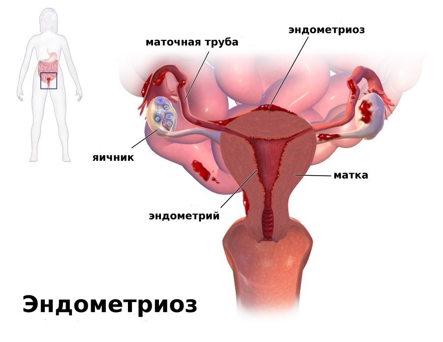 Трава боровая матка польза при эндометриозе